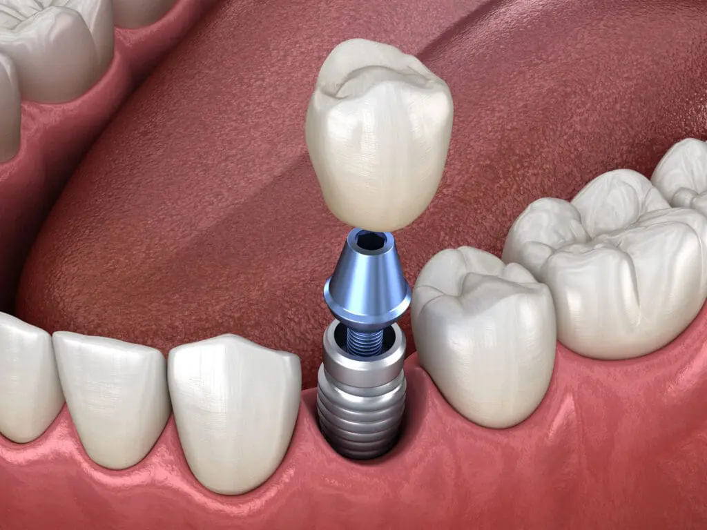 Illustration 3D d'un implant dentaire
